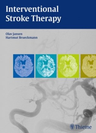Interventional Stroke Therapy фото книги