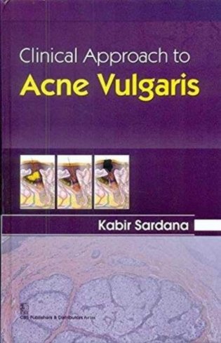 Clinical approach to acne vulgaris фото книги