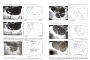 Практическая ультразвуковая диагностика. Том 3. Ультразвуковая диагностика заболеваний женских половых органов фото книги 2