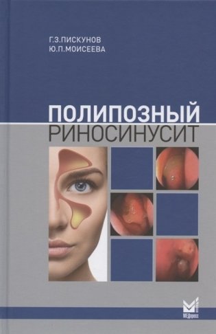 Полипозный риносинусит фото книги