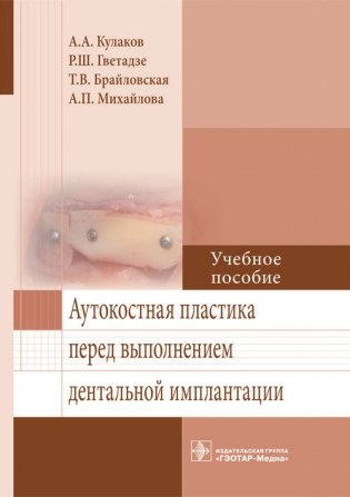 Аутокостная пластика перед выполнением дентальной имплантации фото книги