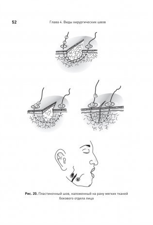 Хирургический шов. 3-е издание, обновленное фото книги 8