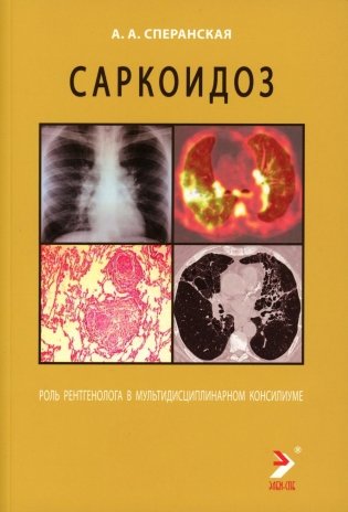 Саркоидоз. Роль ренгенолога в мультидисциплинарном консилиуме фото книги