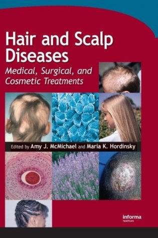 Hair and Scalp Diseases: Medical, Surgical, and Cosmetic Treatments фото книги